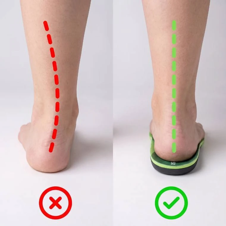 Side-by-side of an ankle collapsing inward versus held straight on an XSTANCE insole