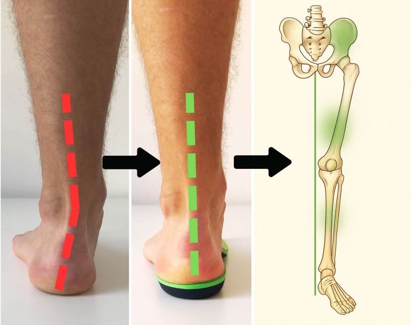 Before and after foot alignment illustration